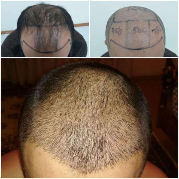 Пересадка волос в Бухаре (новая услуга в регионе)