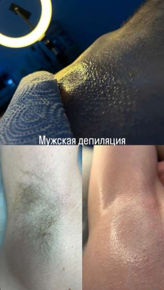Депиляция