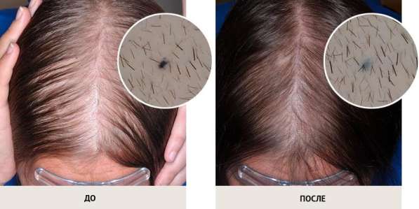 Решение проблемы выпадения волос, активация роста волос в Волгограде фото 8