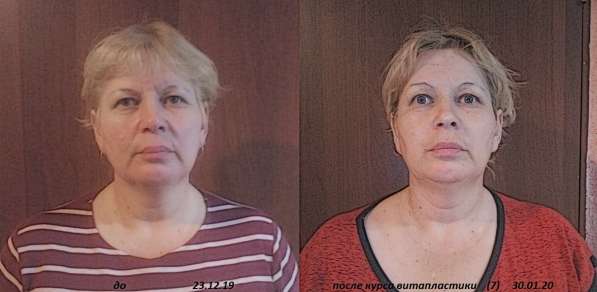 Массаж-Омоложение лица и шеи- Витапластика в Краснодаре фото 5