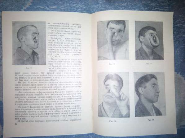 Пластические операции на лице 1953г в Чите