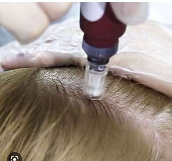 Мезотерапия волос от выпадения в Москве фото 4